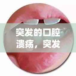 突发的口腔溃疡,突发口腔溃疡吃什么好的快